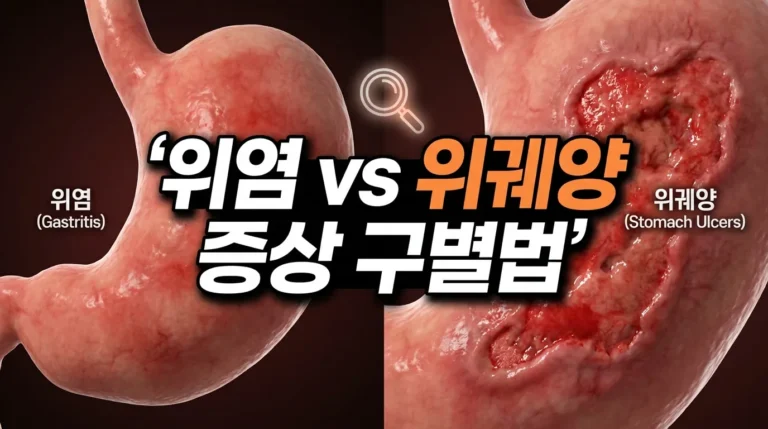 위염과 위궤양구별법